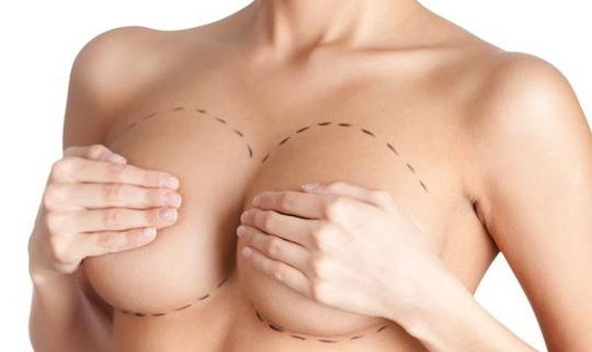 Implants anatomiques augmentation mammaire