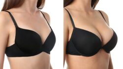 chirurgie seins avant après