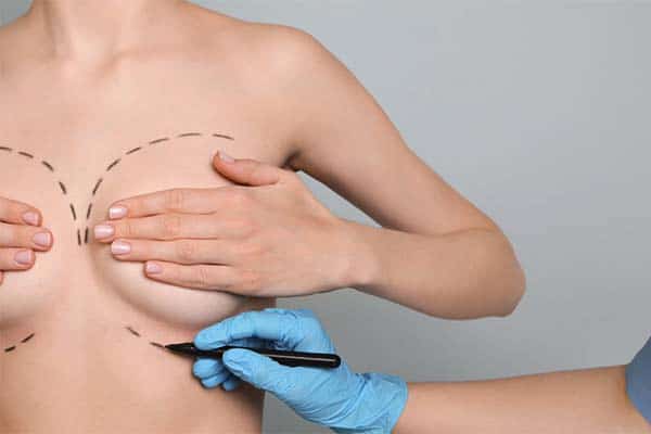 Augmentation mammaire avec implants et lipofilling